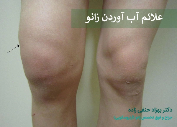 آب آوردن زانو چه علائمی دارد؟