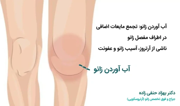 آب آوردن زانو