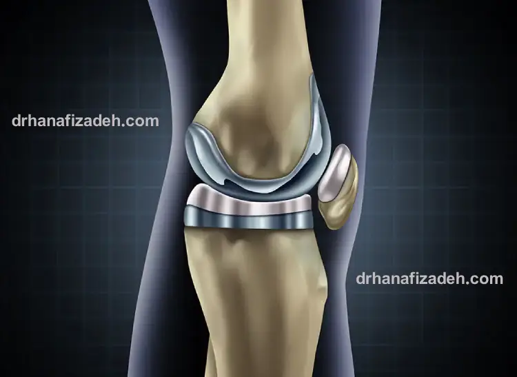 طول عمر پروتز زانو
