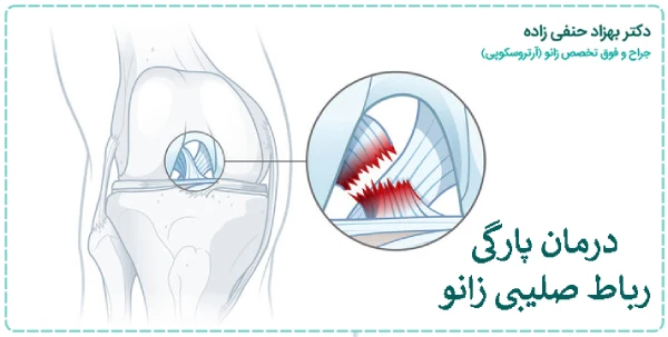 درمان پارگی رباط صلیبی زانو