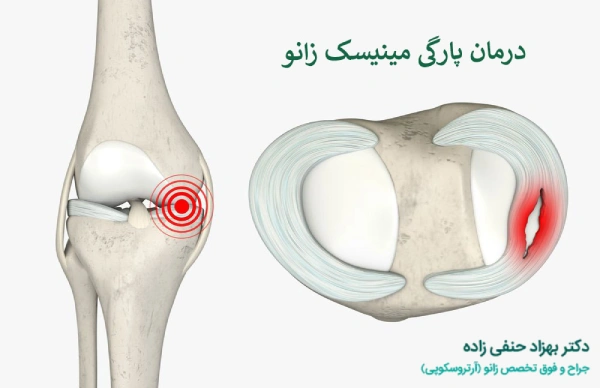 درمان پارگی مینیسک زانو