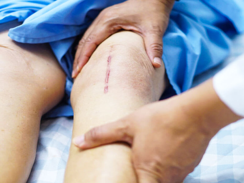 تفاوت تعویض مفصل و تعویض کامل زانو
