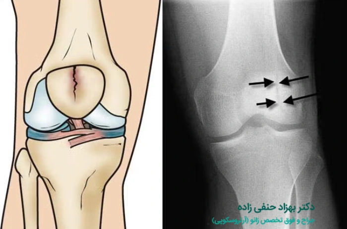 انواع شکستگی کشکک زانو