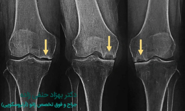 نکروز آواسکولار زانو چیست؟