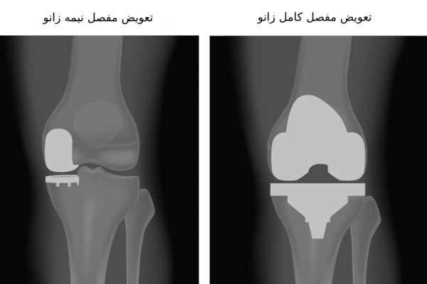 جراحی تعویض مفصل نیمه زانو